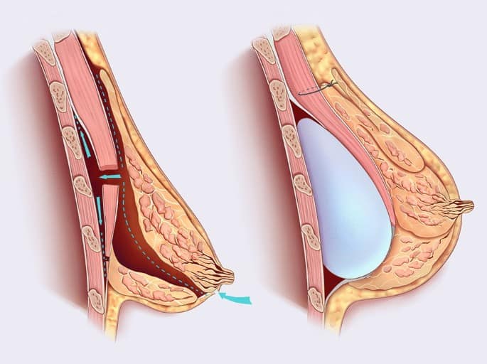 mastoplastica con tecnica dual plane