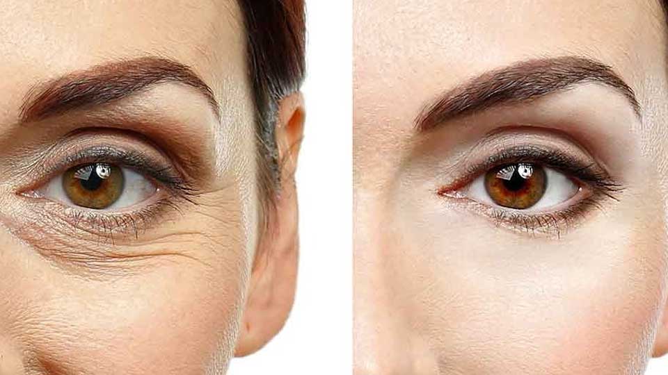Blefaroplastica: tutto ciò che devi sapere sull’intervento di chirurgia estetica per il ringiovanimento degli occhi