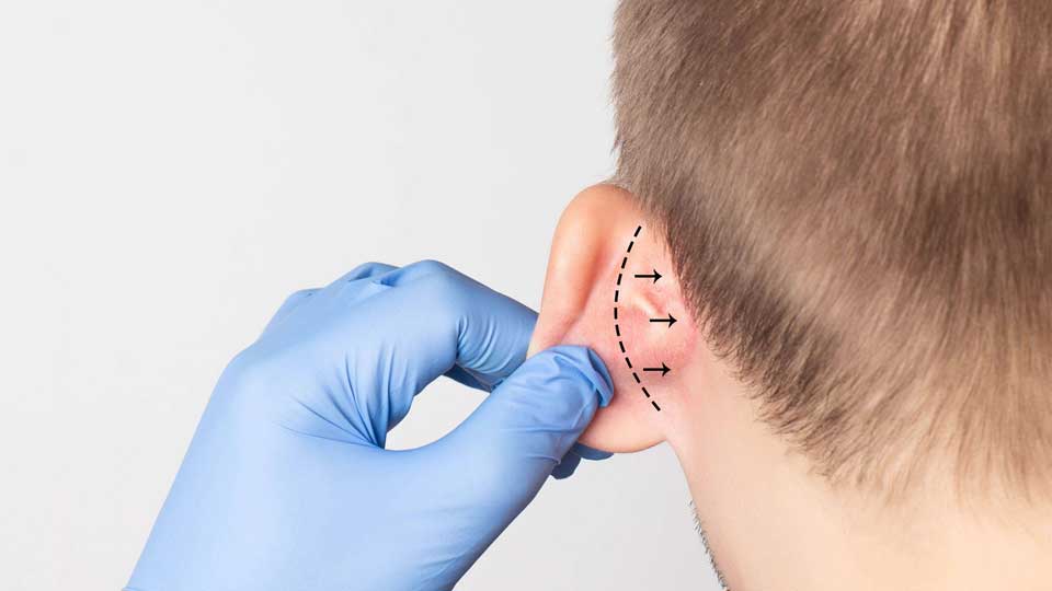 Otoplastica: la soluzione all’inestetismo delle orecchie a sventola