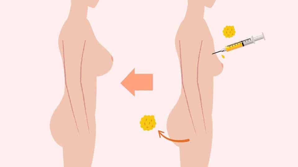 Dal grasso in eccesso alla bellezza: tutto ciò che devi sapere sul lipofilling