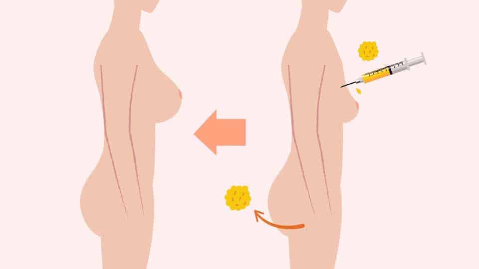 Dal grasso in eccesso alla bellezza: tutto ciò che devi sapere sul lipofilling