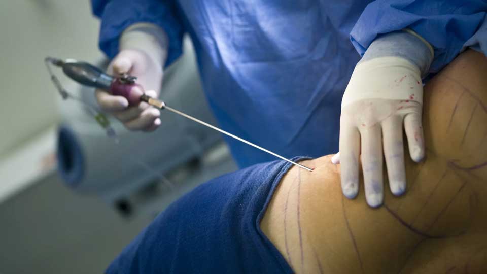 I benefici e i rischi della liposuzione: cosa devi sapere prima di sottoporsi all’intervento