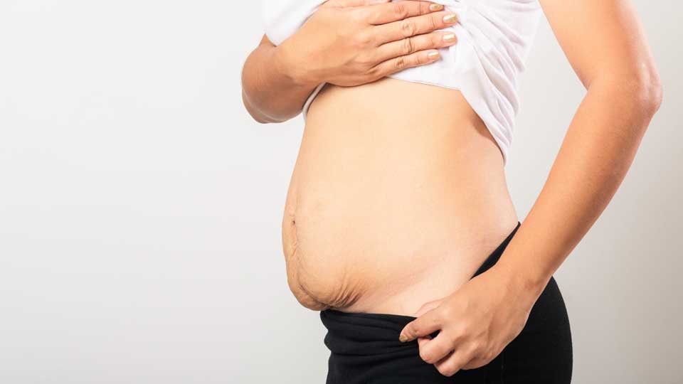 Mommy Makeover: tutto ciò che devi sapere sulla chirurgia estetica post-gravidanza
