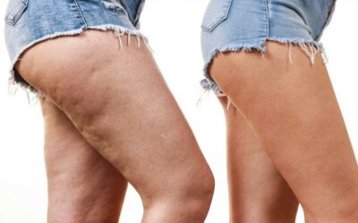 Come combattere la cellulite: i trattamenti più efficaci chirurgici e non per migliorare l’aspetto del proprio corpo