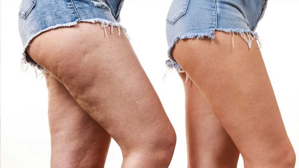 Come combattere la cellulite: i trattamenti più efficaci chirurgici e non per migliorare l’aspetto del proprio corpo