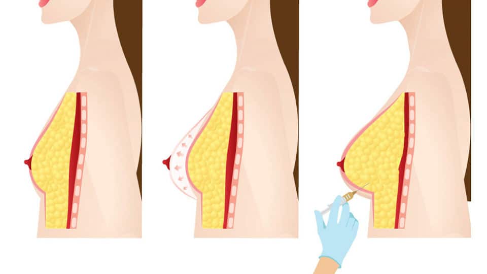 Lipofilling seno prima e dopo, costi