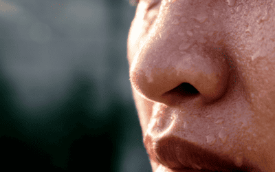 Iperidrosi facciale: come intervenire
